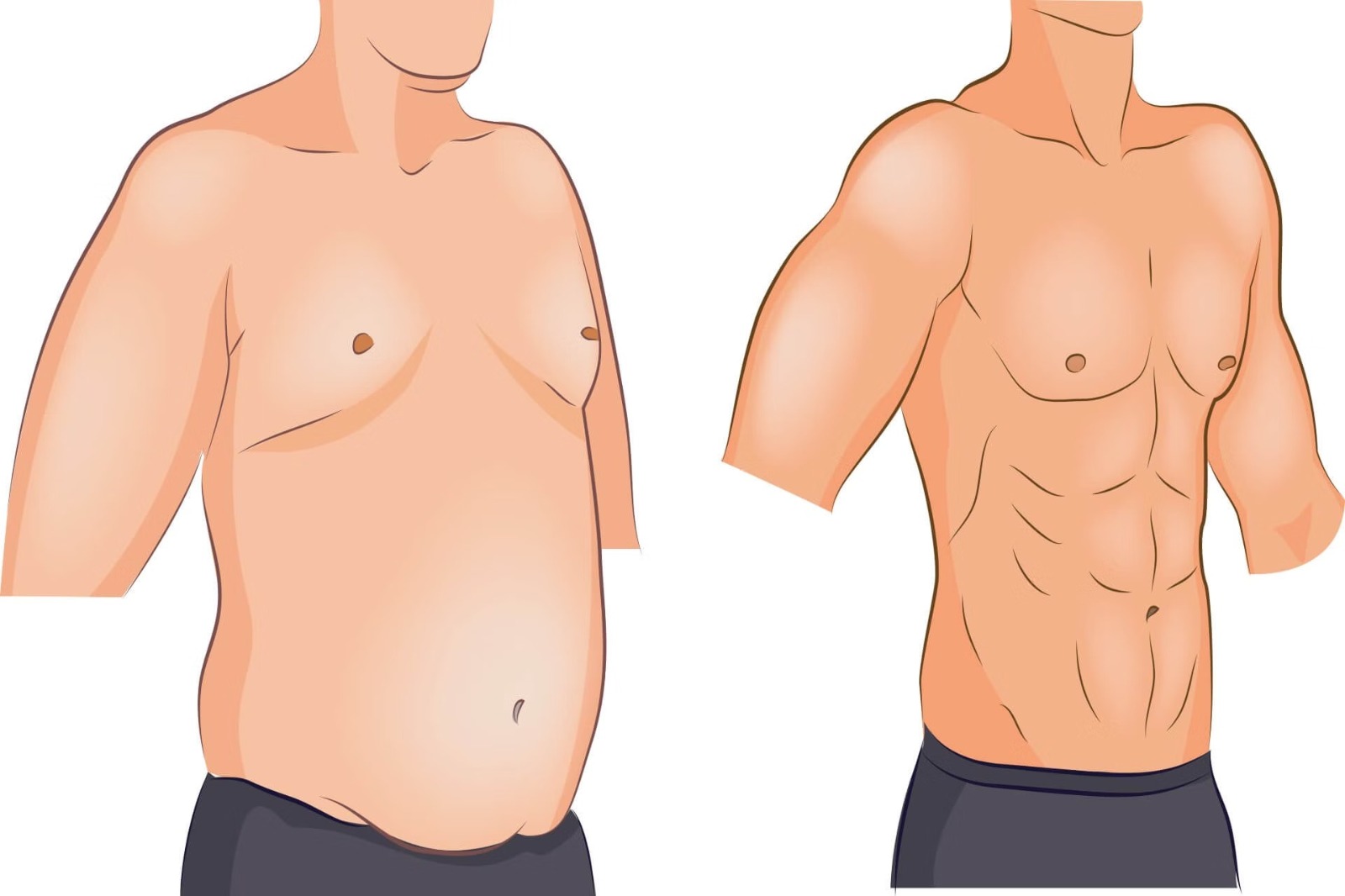 Gynecomastia